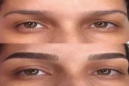 After and Before Eyebrow Hair Transplant