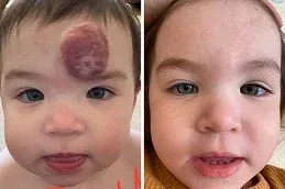 After and Before hemangiomas Treatment