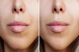 Befor and After Lip Fillers Injection
