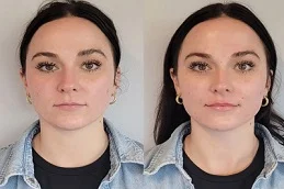 Before & After HydraFacial