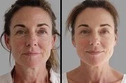 Before-After-Xeomin-treatment-in-Dubai