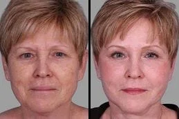 After-Before-Xeomin-treatment