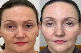 Before and After Botox Injections