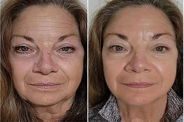 Before and After Dermapen Treatment