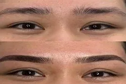 Before and After Eyebrow Hair Transplant