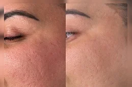 Before and After Facial Capillaries Treatment