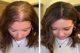 Before and After PRP