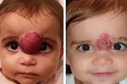 Before and After hemangiomas Treatment