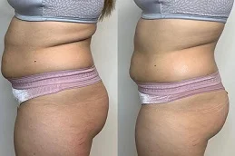 Before and After liposonix tratament