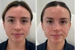 Botox Injections After and Before 