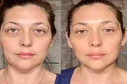 Botox Injections Before and After