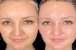 Dermapen Treatment After and Before