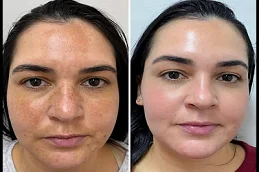 Dermapen Treatment Before and After