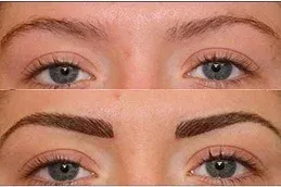 Eyebrow Hair Transplant After and Before
