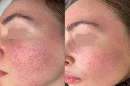 Facial Capillaries Treatment After and Before