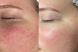 Facial Capillaries Treatment Before and After