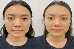 HydraFacial Before & After