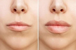 Lip Fillers Injection Befor and After