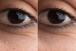 Milia Treatment before and after