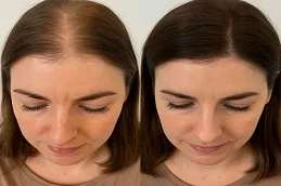 PRP Before and After