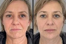Xeomin-treatment-Before-After