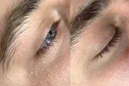 after and before Milia Treatment