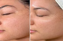 after and before laser skin treatments