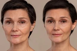 anti aging treatment after and before
