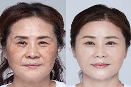 anti aging treatment before and after