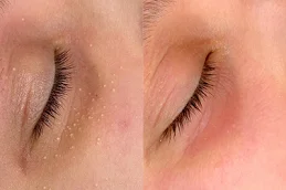 before and after Milia Treatment