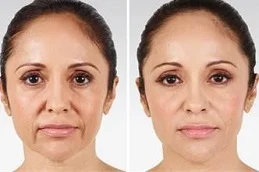 before and after anti aging treatment