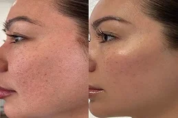before and after laser skin treatments
