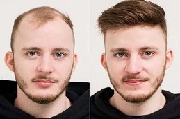 hair transplant before and after
