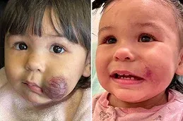 hemangiomas Treatment Before and After