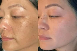 laser skin treatments before and after