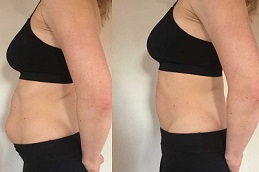 liposonix tratament Before and After