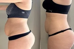 liposonix tratament nd After and Before