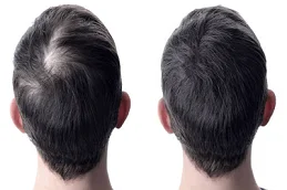 After and Before GFC Treatment For Hair