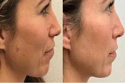 After and Before Mole Removal Treatment