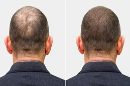 Before and After GFC Treatment For Hair