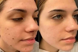 Before and After Mole Removal Treatment