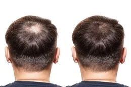 GFC Treatment For Hair After and Before