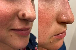 Mole Removal Treatment Before and After