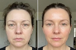 After and Before Endolift