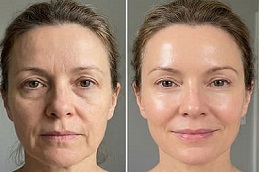 Before and After Endolift
