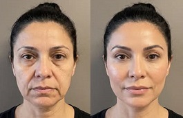 Endolift Before and After