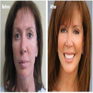 Stemcell Facelift Treatment