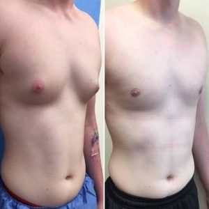 Lipo Chest Surgery