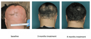 Alopecia Areata Treatment in Dubai, Abu Dhabi & Sharjah