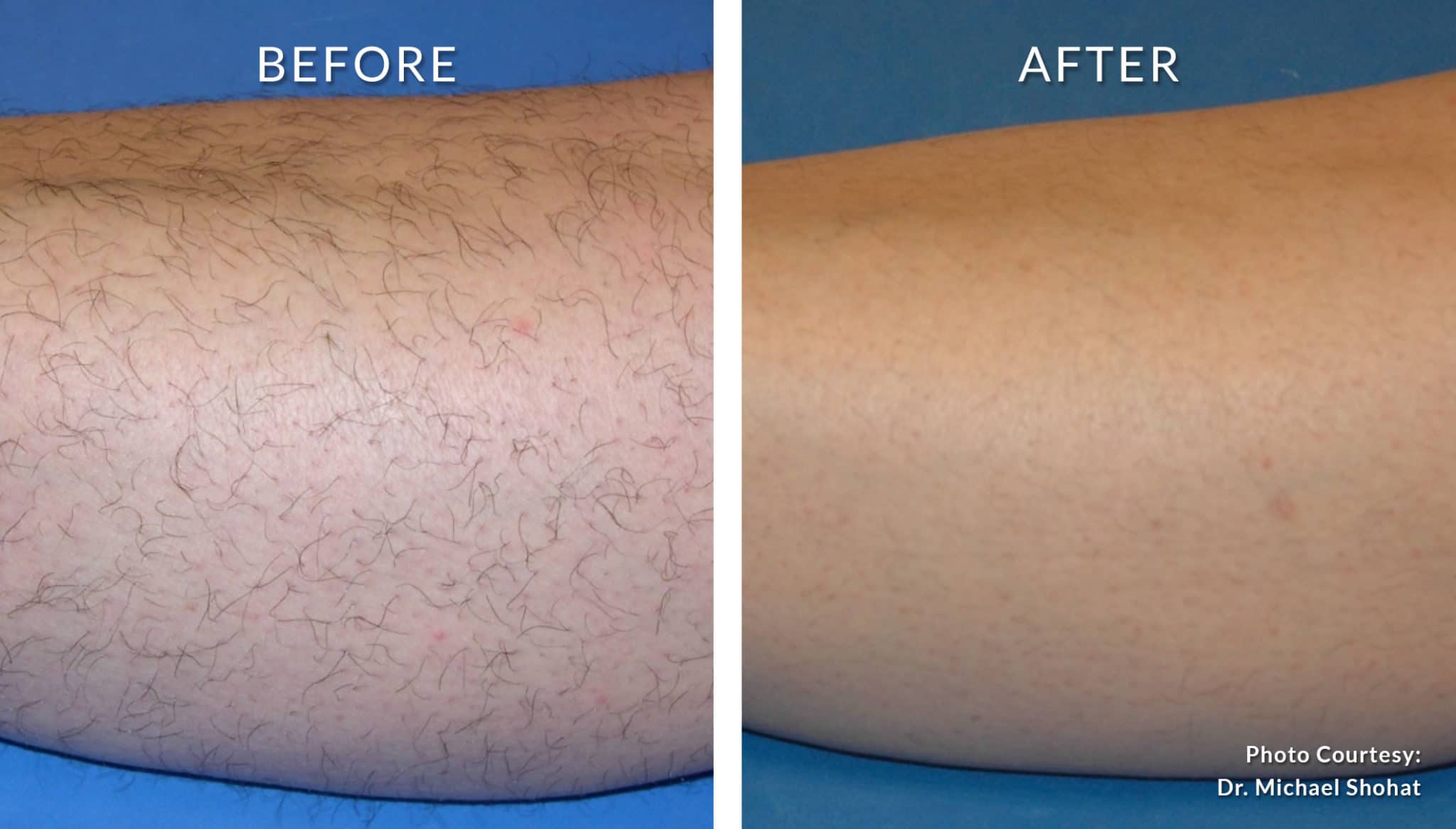 Laser Hair Removal in Blue Mountains - wide 1